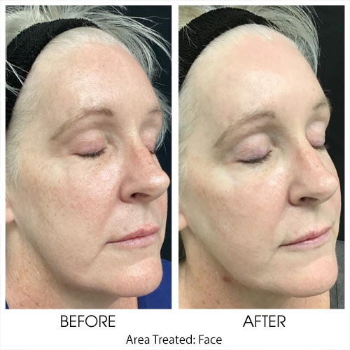 Before + After Gallery: Face